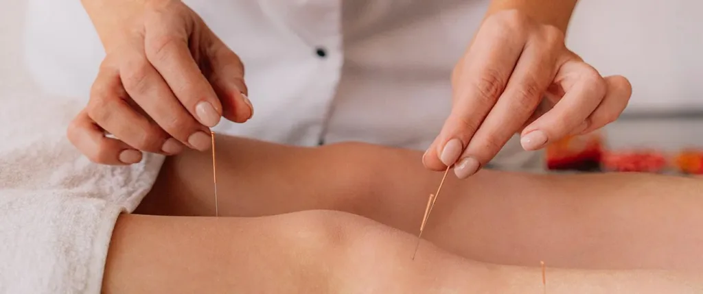 Acupuncture: A Essential Guide for Stress and Anxiety Relief